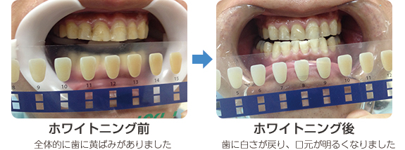 ホワイトニング術前術後